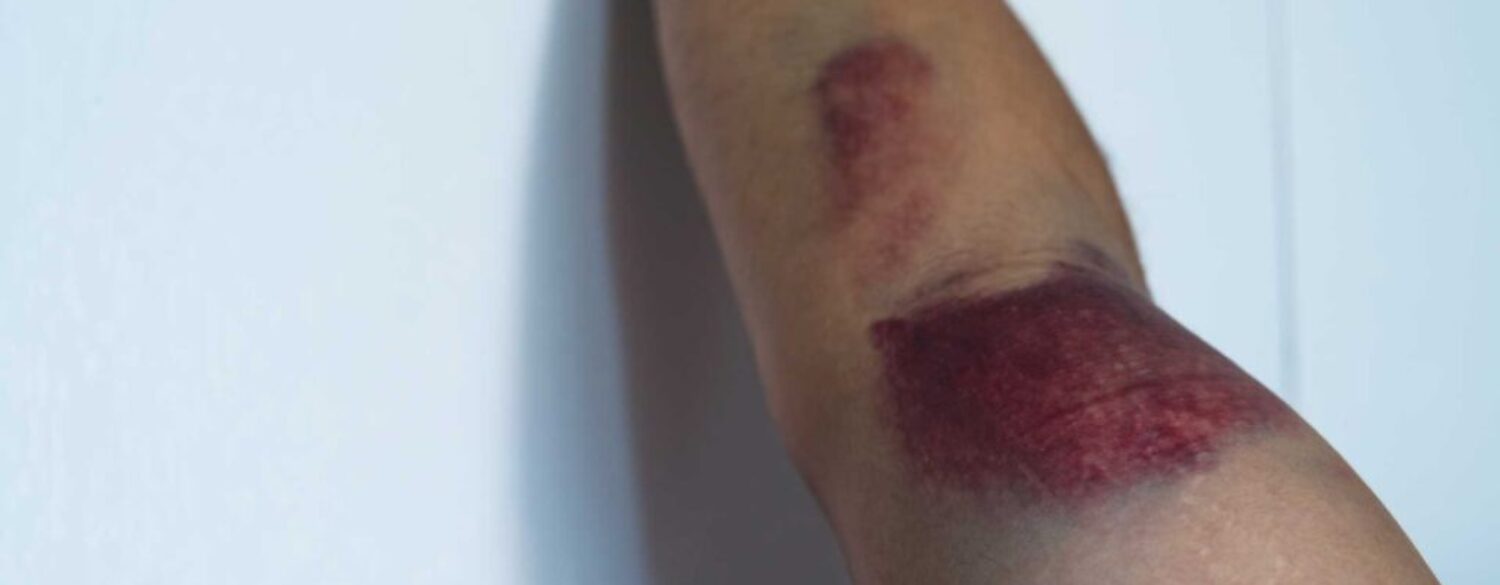 Sports Injuries: Rehabilitation guidance for Bicep Brachii muscle large tear or tendon rupture.