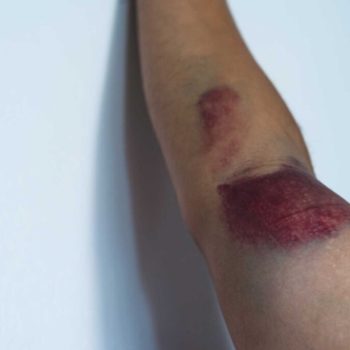 Sports Injuries: Rehabilitation guidance for Bicep Brachii muscle large tear or tendon rupture.